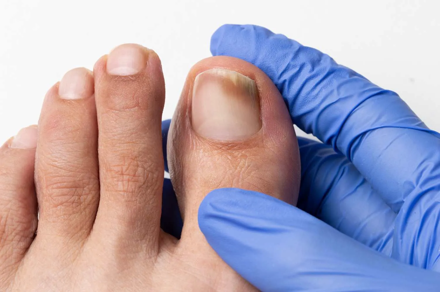 toenail fungus treatment